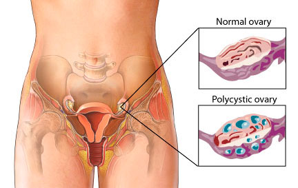 A PCOs szindróma tünetei, és kezelése méhpempővel